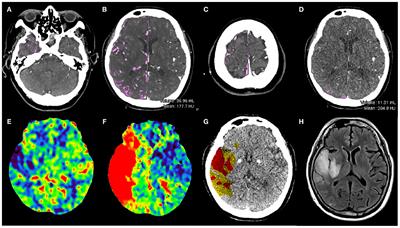 Preliminary Application of a Quantitative Collateral Assessment Method in Acute Ischemic Stroke Patients With Endovascular Treatments: A Single-Center Study